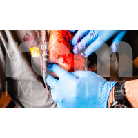 F/X Laceration-Penetrating-Chest-Injury-2